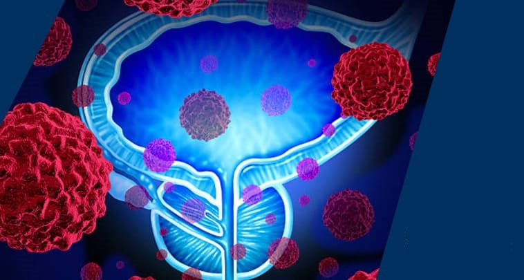 cáncer de próstata